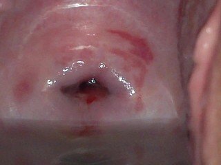 Intense cervix invasion in Filipino